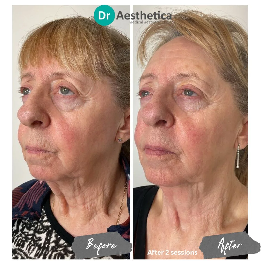 Full Face Lift Skin Tightening with Radiofrequency No Pain no downtime