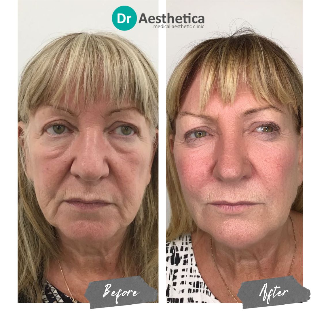 Side-by-side images showing the results of a non-surgical facelift using dermal fillers. The ‘before’ image displays sagging skin and loss of facial volume, while the ‘after’ image reveals a lifted, more contoured face with restored volume and smoother skin, demonstrating the rejuvenating effects of dermal fillers.