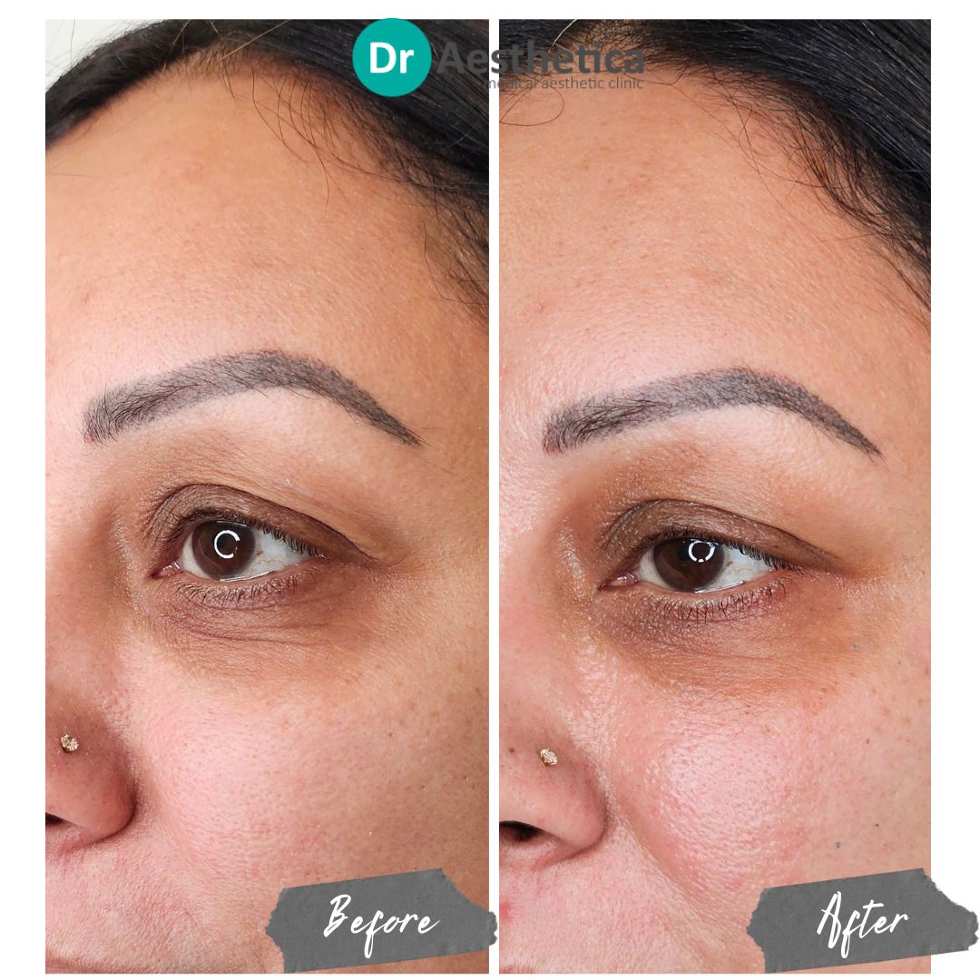 Sunekos Under eye and Upper Eye Lid Improvement Alternative to tear trough Filler