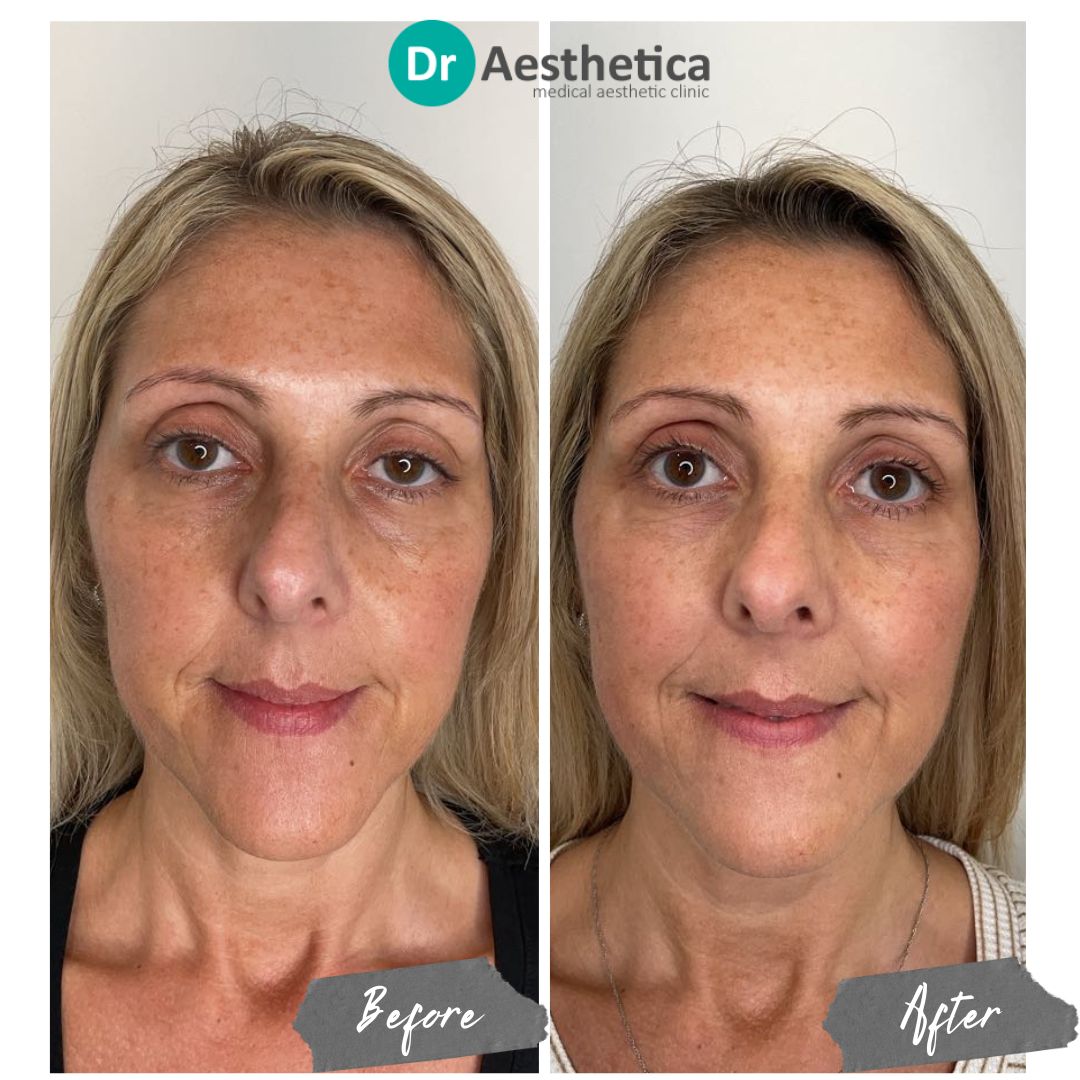 Sunekos Face Natural Filler skin Improvement