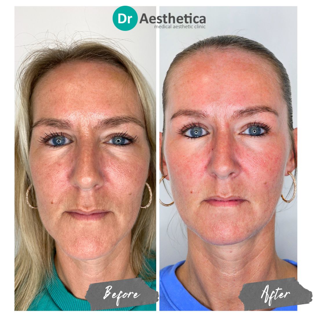 Side-by-side comparison of a woman’s face before and after Sunekos treatment. The ‘before’ image shows fine lines, dull skin, and a loss of elasticity, while the ‘after’ image reveals smoother, more hydrated skin with a noticeable reduction in fine lines and a radiant, youthful glow, illustrating the rejuvenating effects of Sunekos.