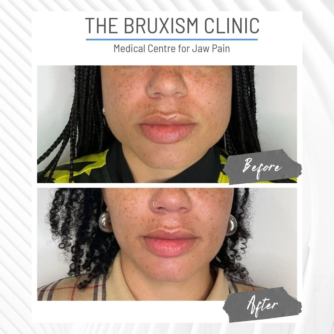 The Bruxism Clinic at Dr Aesthetica for Bruxism Botox