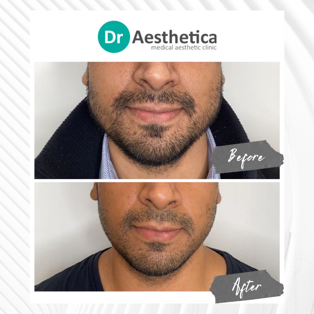 A patient receiving Botox injections for facial contouring, particularly along the jawline. This non-surgical approach helps create a more sculpted and attractive jawline.