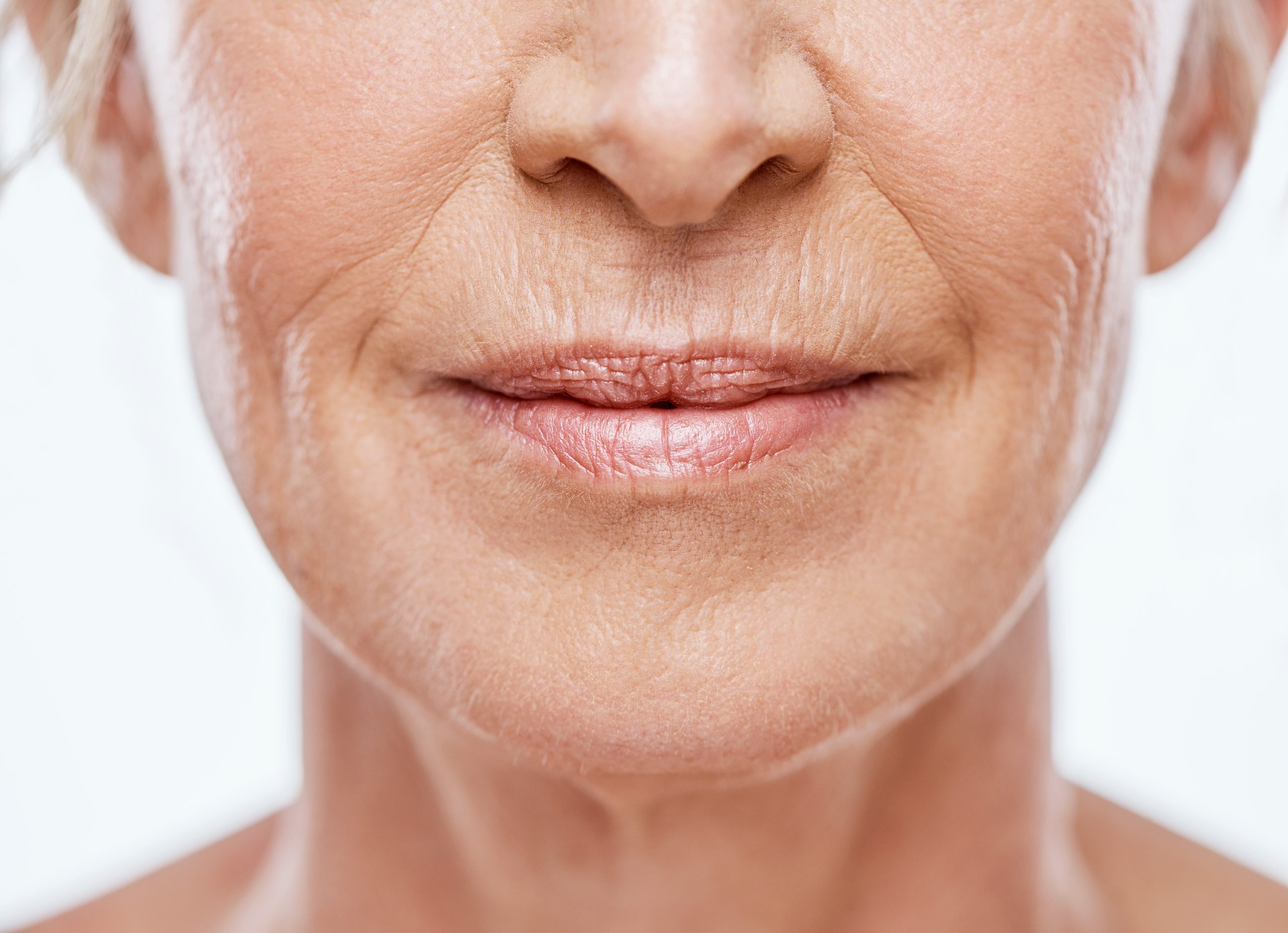 Targeting Smoker’s Lines with Dermal Fillers