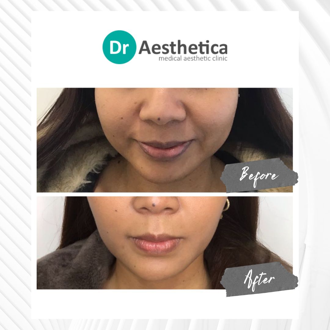 Before and after Jawline Botox at Dr. Aesthetica Birmingham showing improved jawline contour and facial definition.
