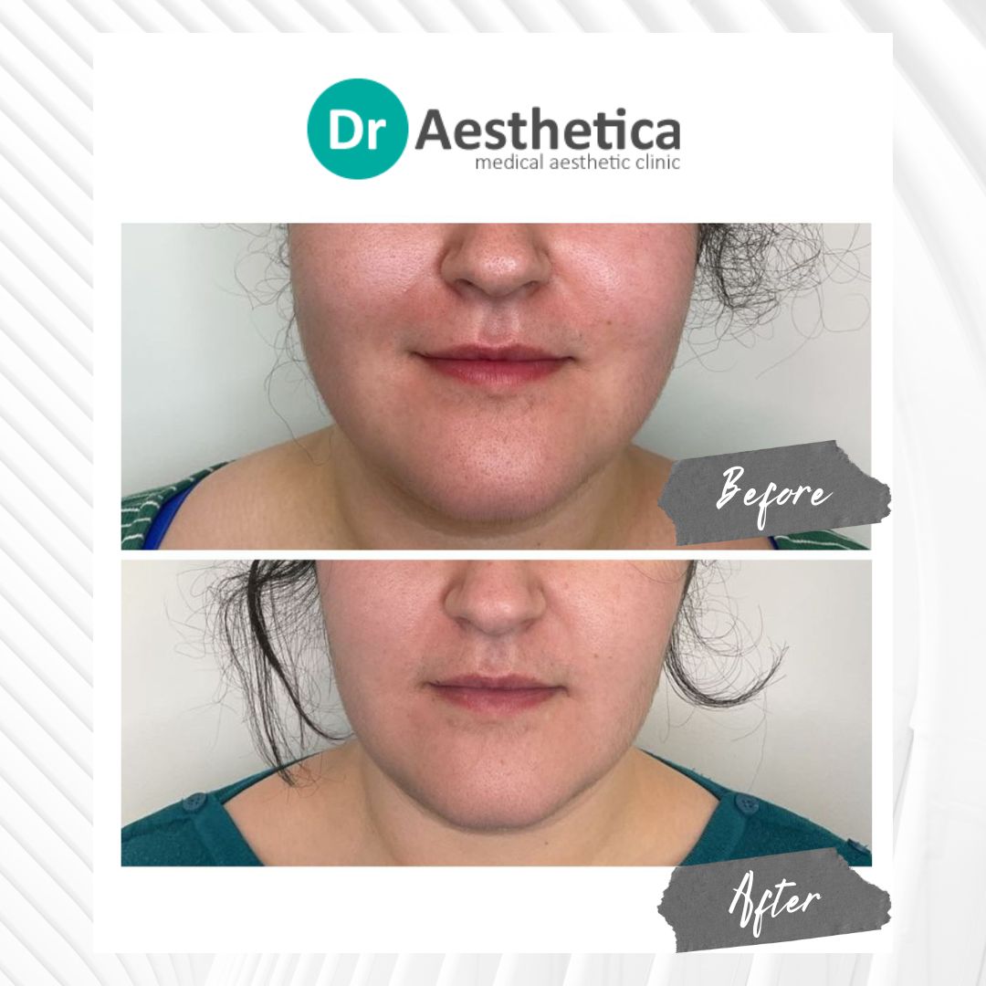 Close-up of a Botox treatment session focused on jawline enhancement. The image shows how Botox can refine and slim the jawline area.