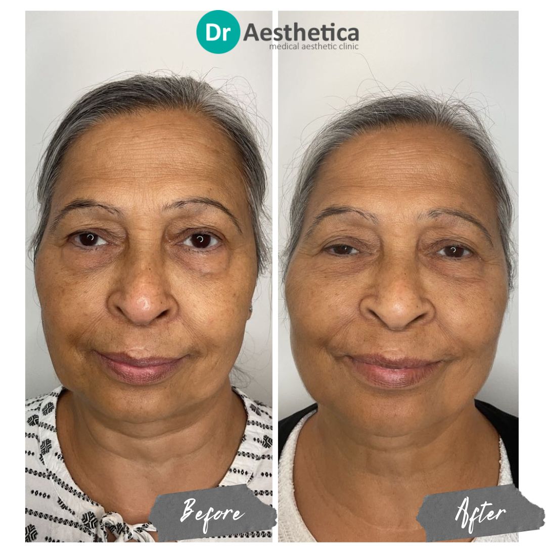 Sunekos skin revitalisation results—hydrated, youthful complexion after treatment at Dr. Aesthetica Birmingham.