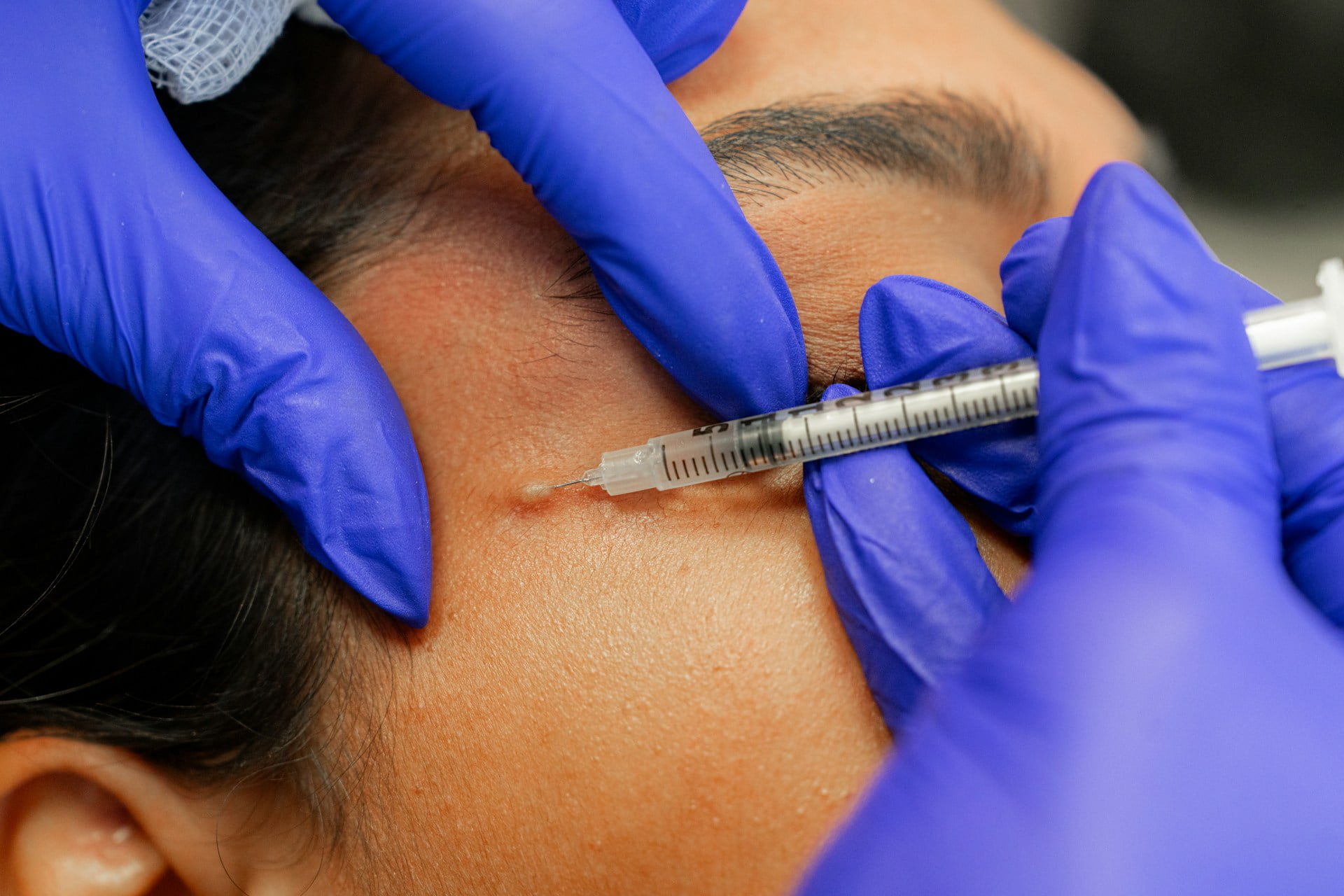Under Eye Hollows Why Fillers Are a Great Solution