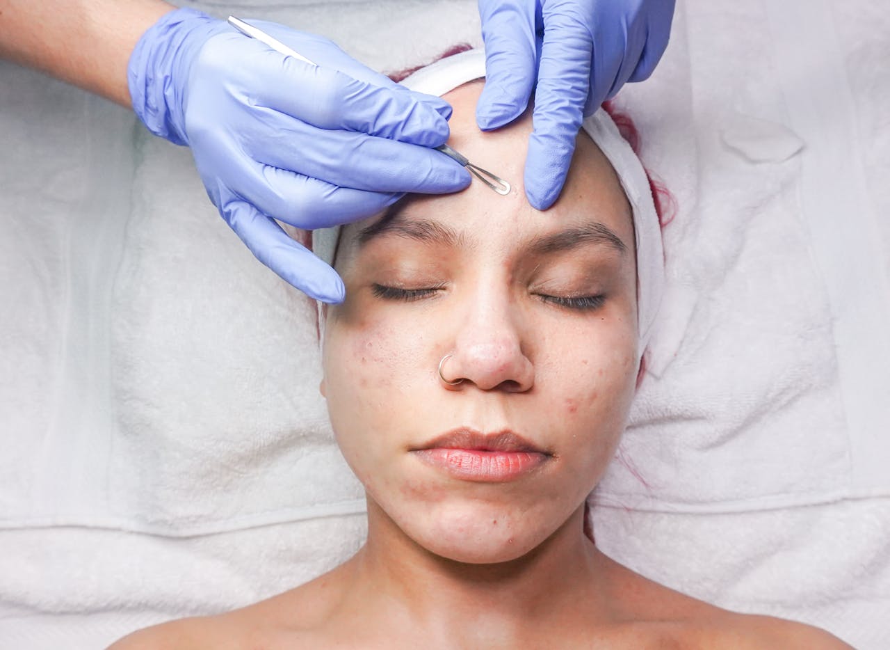 Dealing with Acne Scarring: Best Treatments to Consider