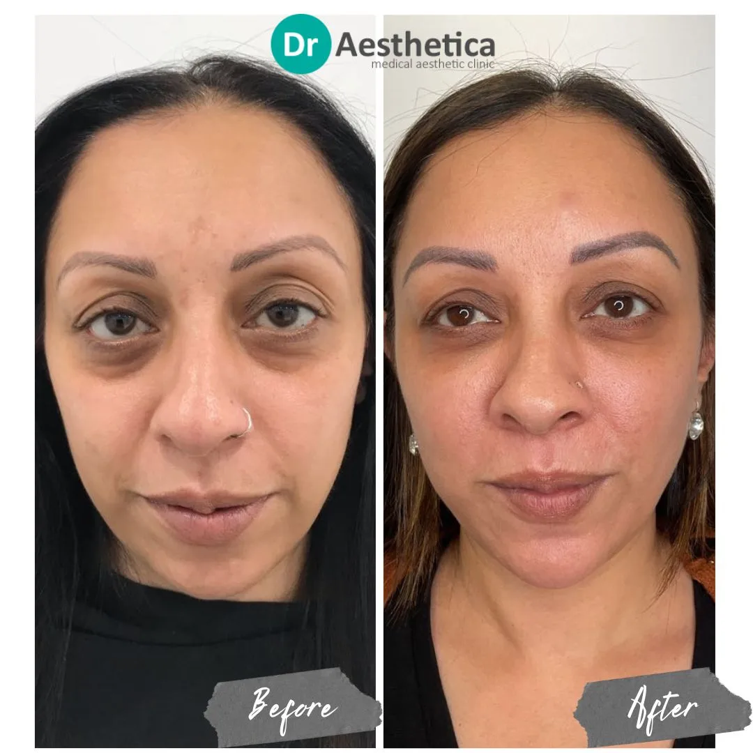 Face Lift