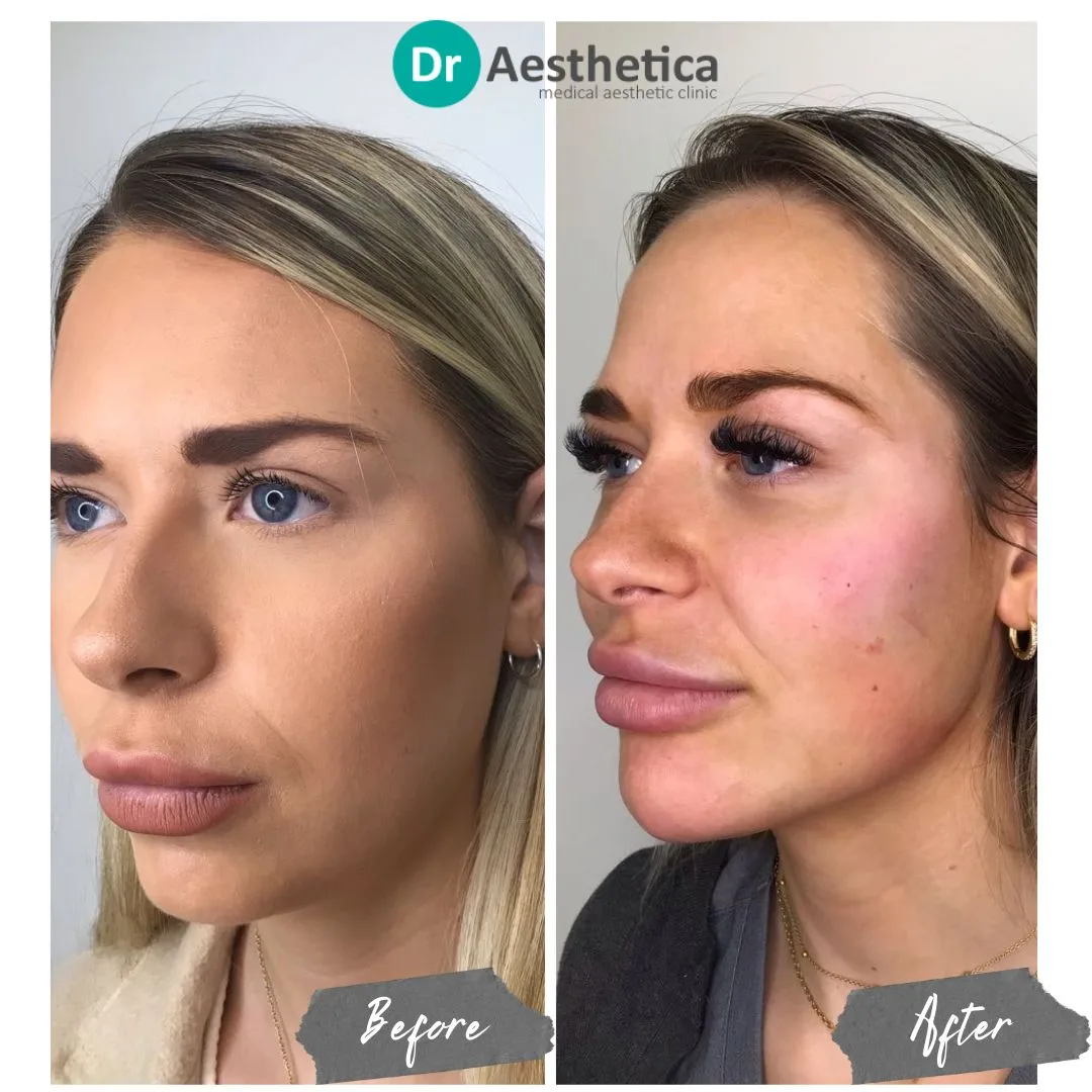 Jawline Filler