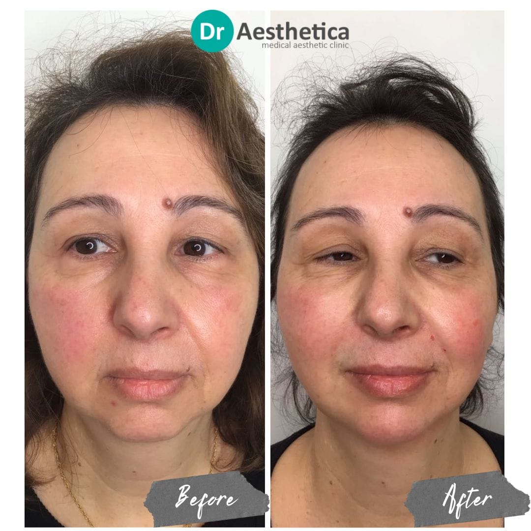 Before and after chin filler treatment at Dr. Aesthetica Birmingham showing enhanced facial balance and profile definition.