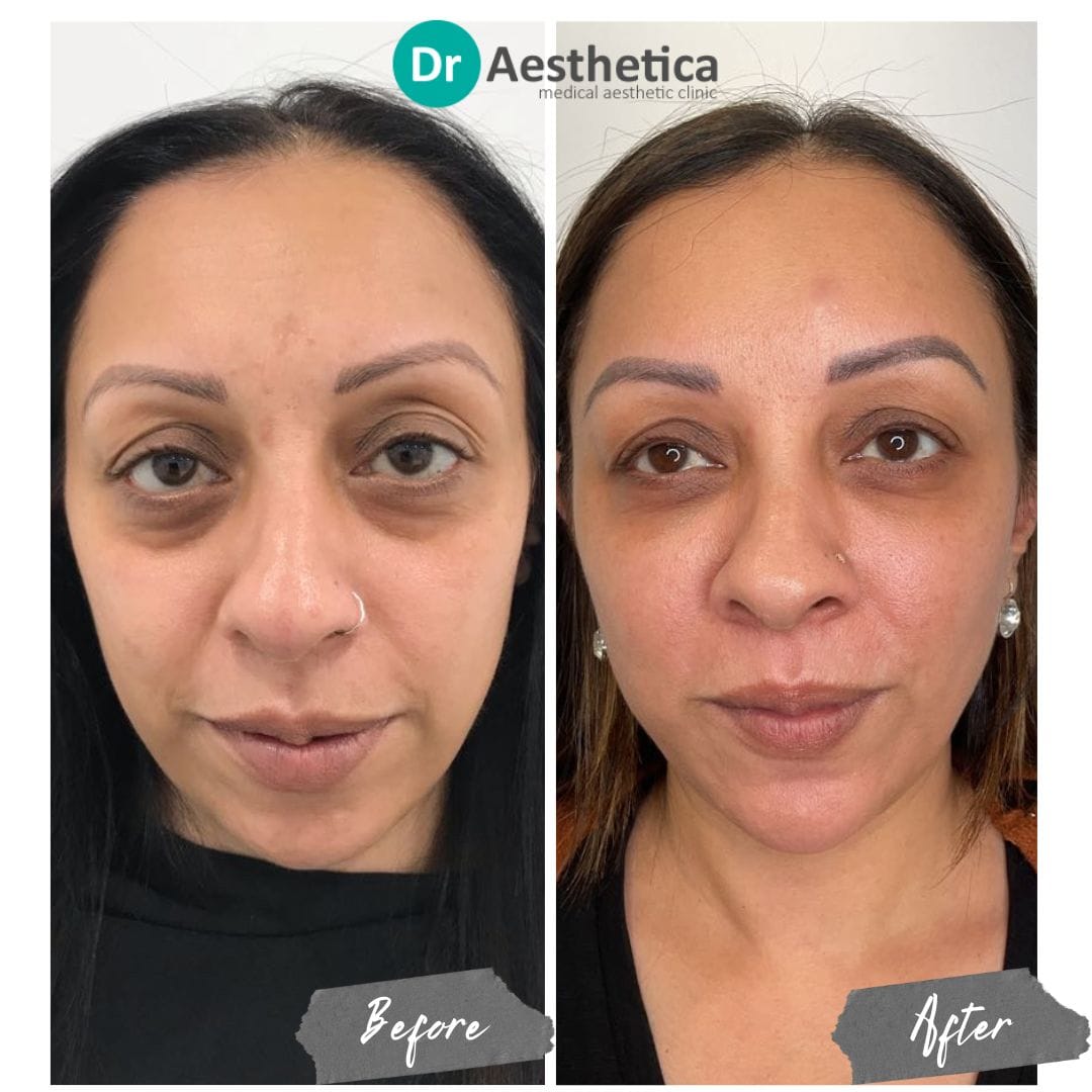A female who has received a non surgical Face Lift at dr aesthetica's birmingham clinic
