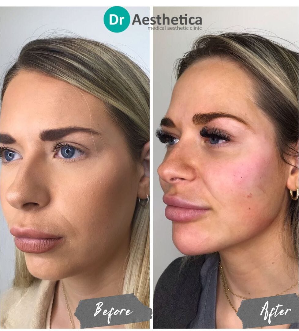 Before and after jawline filler treatment at Dr. Aesthetica Birmingham showing sharper contour and defined jawline.