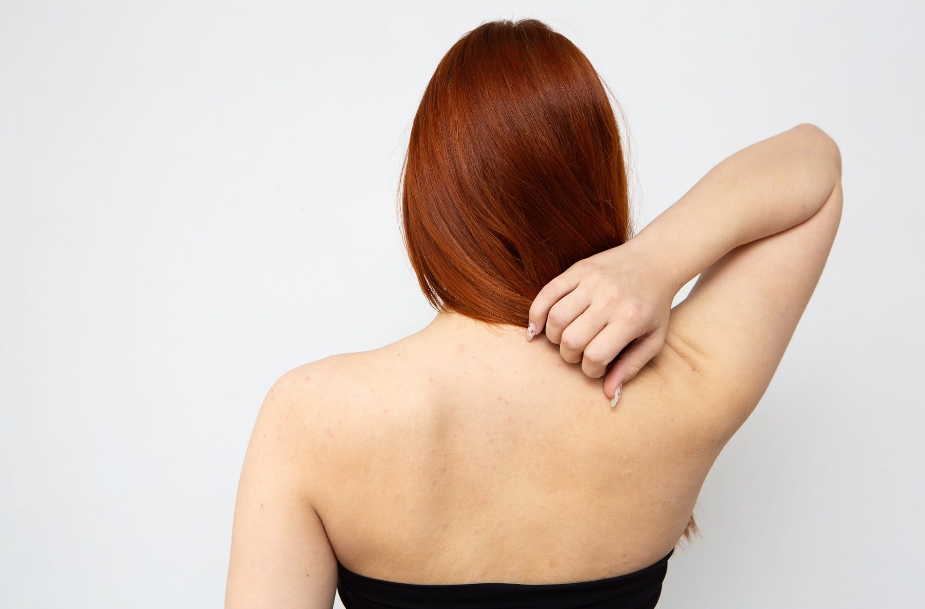 Back and Chest Acne: Effective Treatments Explained