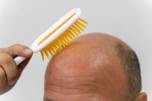 Hair Exosome Treatment