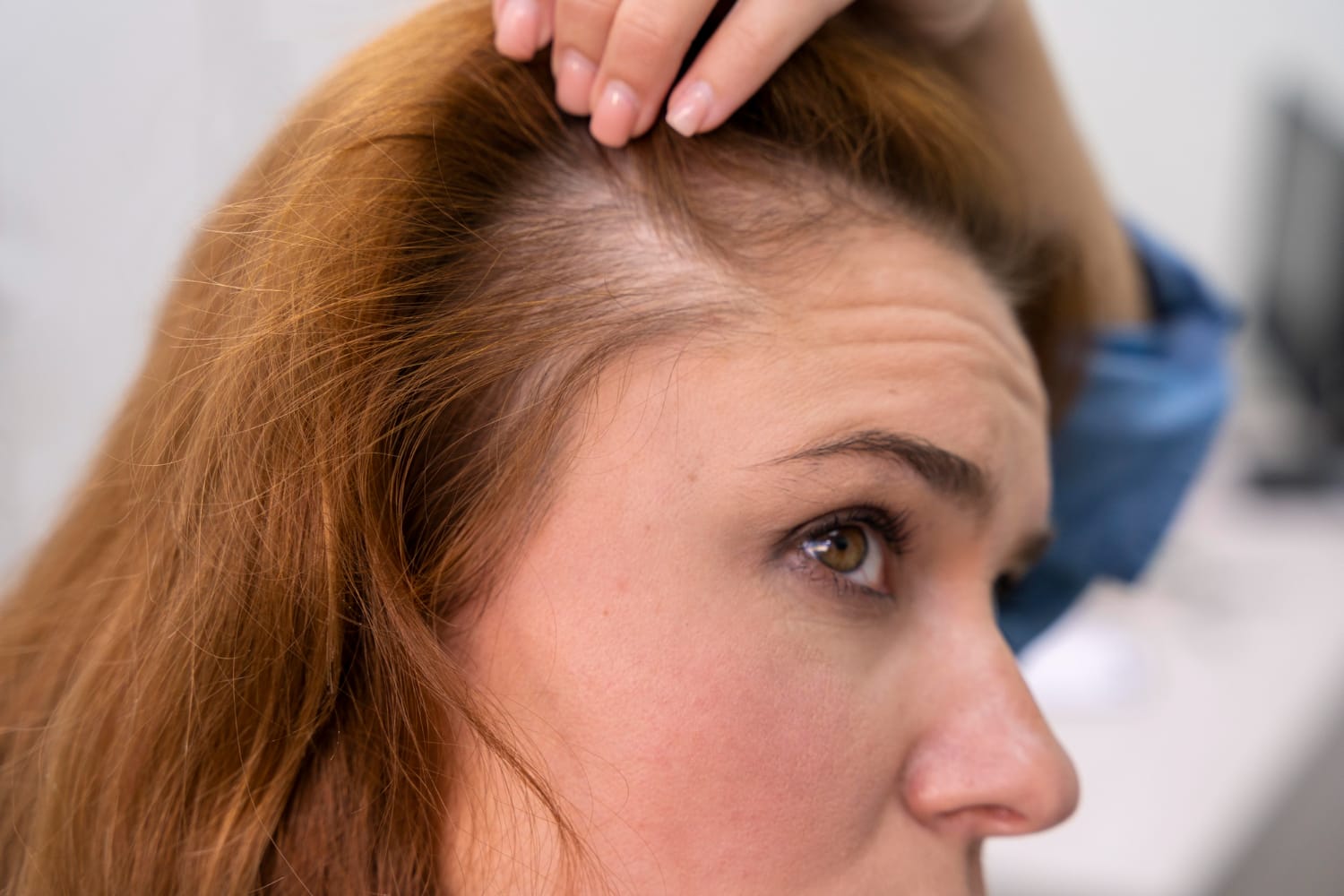 Best Tips for Managing Female Hair Loss in West Midlands