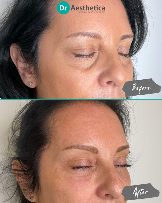 Before and after of female patient with deep tear trough grooves treated at Dr. Aesthetica in Birmingham, showing smoother under-eye contour and improved volume.
