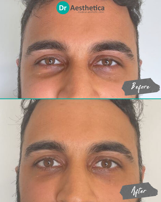 Before and after of male patient treated with 1ml tear trough filler at Dr. Aesthetica, Birmingham, to reduce under-eye hollowness and dark shadows.