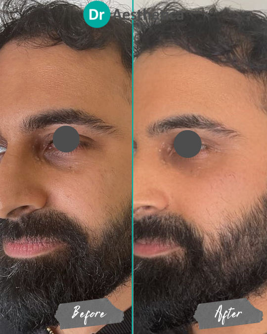 Before and after image of a male patient treated with tear trough filler at Dr. Aesthetica in Birmingham, showing improved under-eye volume and reduced hollowness.