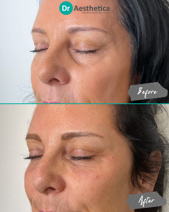 Before and after image of a female patient treated with tear trough filler at Dr. Aesthetica in Birmingham, showing natural under-eye volume restoration with a refreshed appearance.
