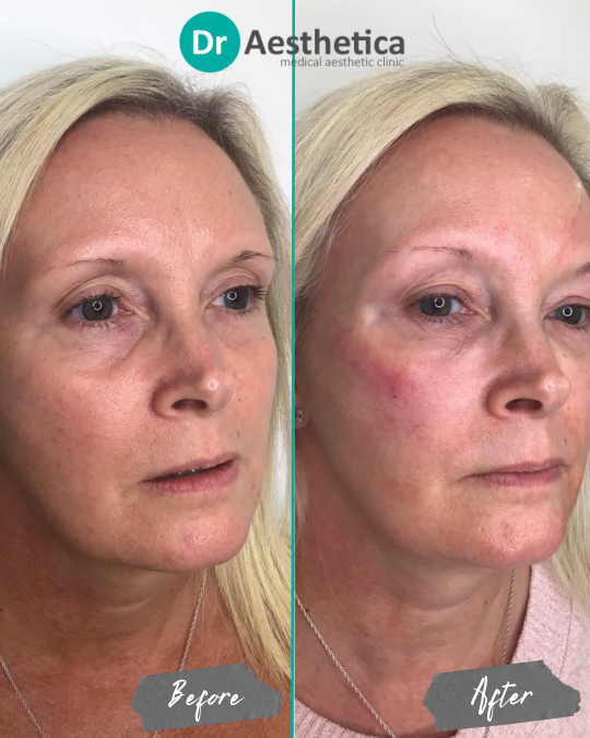 Before and after image of a female patient treated at Dr. Aesthetica in Birmingham with dermal filler to the tear trough and cheeks, reducing under-eye hollowness and improving facial volume.