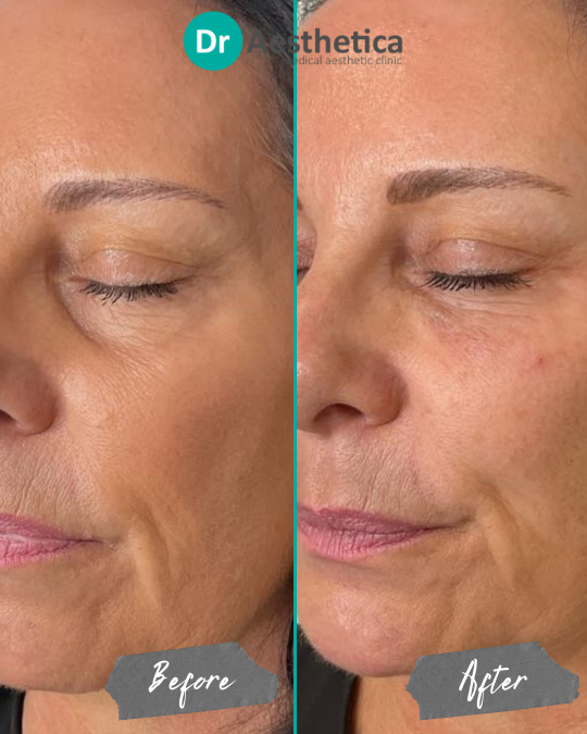 Before and after tear trough filler results on female patient at Dr. Aesthetica in Birmingham, showing reduced hollowness and improved under-eye smoothness.