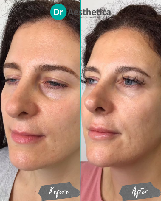 Before and after of female patient treated with tear trough filler at Dr. Aesthetica, Birmingham, showing improved under-eye volume and reduced dark circles.