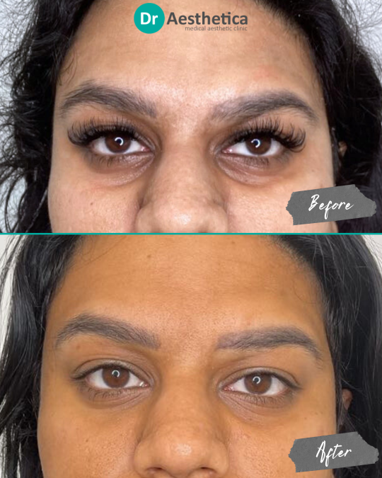 Before and after image of female patient with darker skin tone treated at Dr. Aesthetica in Birmingham using tear trough filler to reduce under-eye darkness and hollowness.