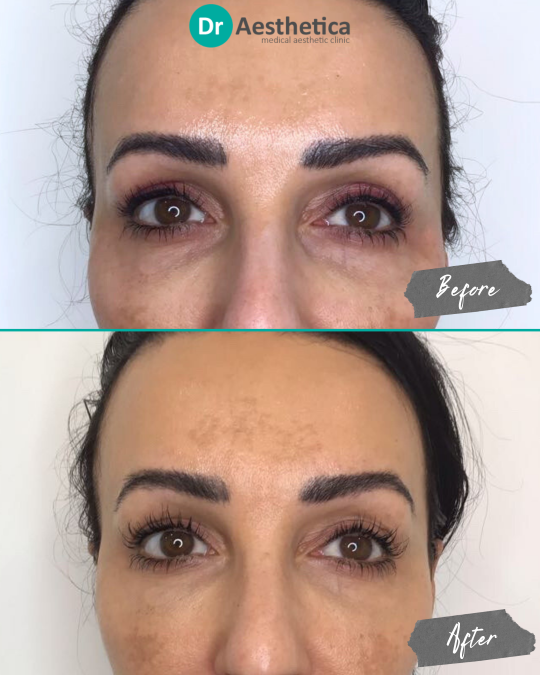 Before and after image of female patient treated at Dr. Aesthetica, Birmingham, with tear trough filler to reduce tired appearance and makeup creasing under the eyes.