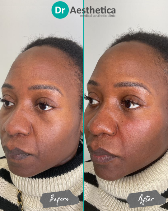 Before and after image of female patient with darker skin tone treated at Dr. Aesthetica, Birmingham, using tear trough filler to reduce under-eye shadowing and enhance mid-face volume.