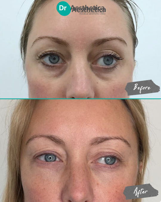 Before and after image of a female patient treated at Dr. Aesthetica in Birmingham with tear trough filler to reduce under-eye bags and puffiness.