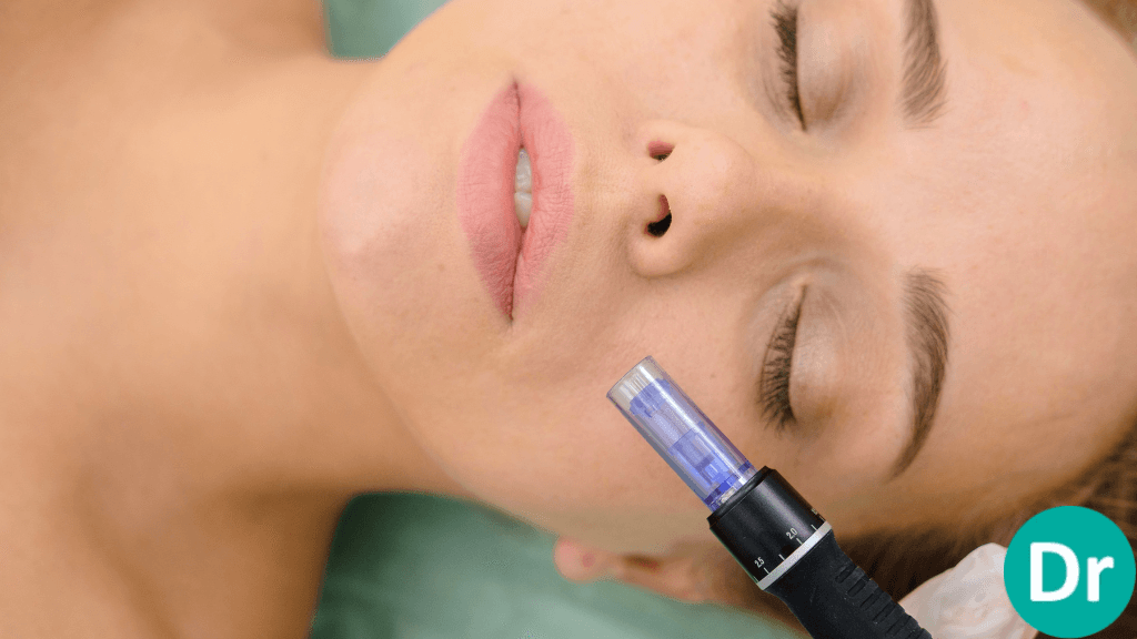 Microneedling and freckles