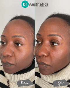 A female patient inside our birmingham clinic both before and after tear trough filler treatment