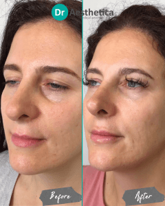 A patient in our birmingham clinic who received tear trough filler