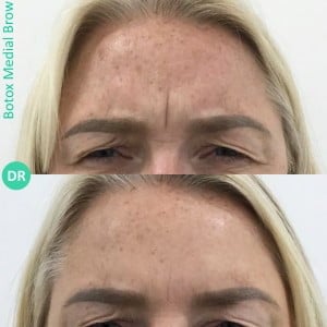 Before and After image of a woman who has received botox brow lift treatment at our birmingham clinic