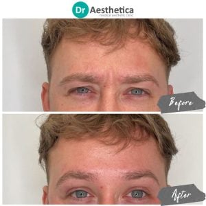 A man who has received a botox brow lift at our birmingham clinic