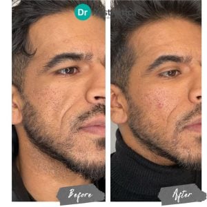 Cheek filler results demonstrating lifted and youthful cheek definition, performed by Dr. Aesthetica Birmingham.