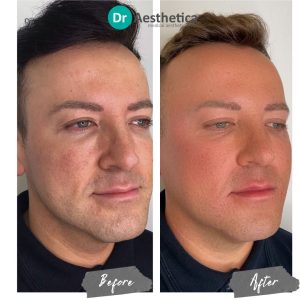 Natural-looking cheek filler transformation carried out at Dr. Aesthetica, Birmingham’s leading aesthetic clinic.