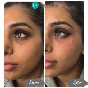 Cheek filler before and after comparison showing enhanced symmetry and rejuvenation at Dr. Aesthetica Clinic.