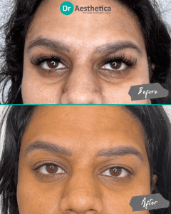 a before and after of a woman inside our birmingham clinic who received tear trough filler