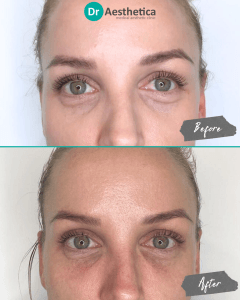 A woman who received tear trough filler in our birmingham clinic