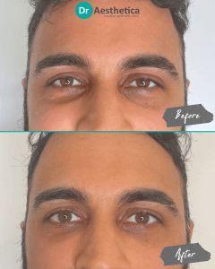 A man who received tear trough filler in our birmingham clinic