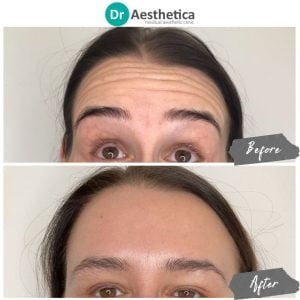 A before and after of a woman who has received forehead botox at dr aesthetica's birmingham clinic