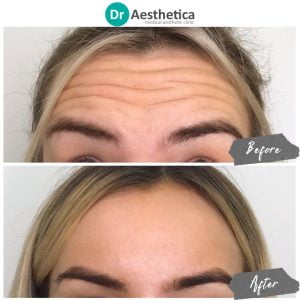 A lady both before and after receiving forehead botox at Dr Aesthetica