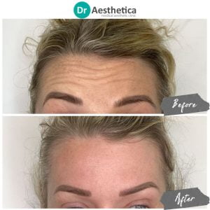A lady both before and after receiving forehead botox at Dr Aesthetica