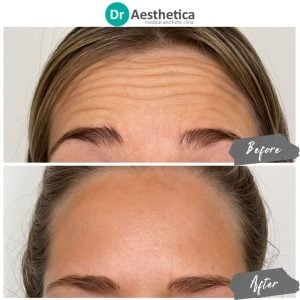 A before and After shot of a patient who received forehead botox at dr aesthetica birmingham