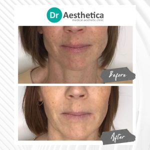 Botox for jawline definition—before and after transformation at Birmingham’s Dr. Aesthetica aesthetic clinic.