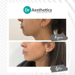 Before and after Botox jawline treatment showing reduced jaw tension and enhanced facial balance at Dr. Aesthetica.