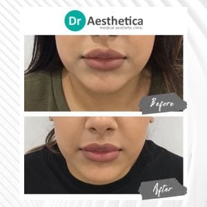Masseter Botox treatment results—refined jawline and slimmer face shape at Dr. Aesthetica Birmingham.